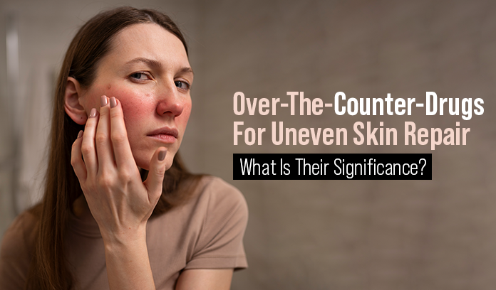 Over-The-Counter-Drugs For Uneven Skin Repair: What Is Their Significance